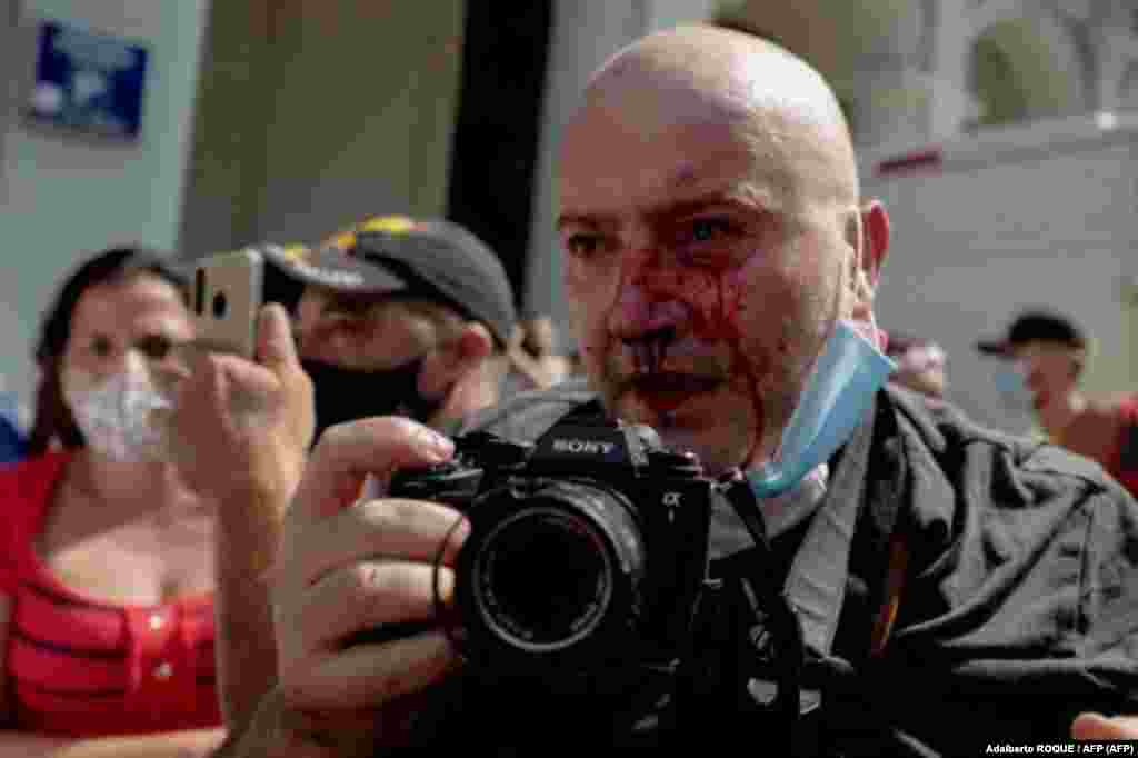 El fotógrafo de AP, el español Ramón Espinosa, aparece con heridas en la cara mientras cubría una manifestación contra el presidente cubano Miguel Díaz-Canel en La Habana, el 11 de julio de 2021. .